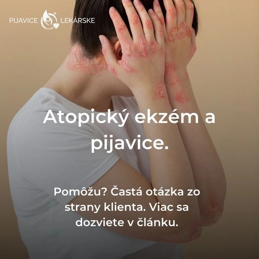 Atopický ekzém a pijavice lekárske