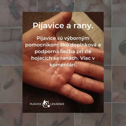 Hirudoterapia a rany